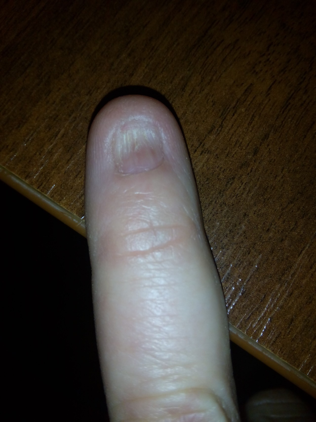 Фото пальца без ногтя на руке