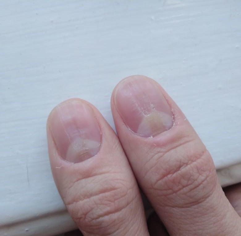 Почему ногти синеют причина. Синюшные ногтевые пластины. Неровности на ногтях рук.