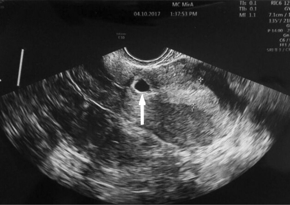Внематочная эндометрий. Шеечная внематочная беременность. Шеечная внематочная беременность УЗИ. УЗИ признаки перфорации матки.