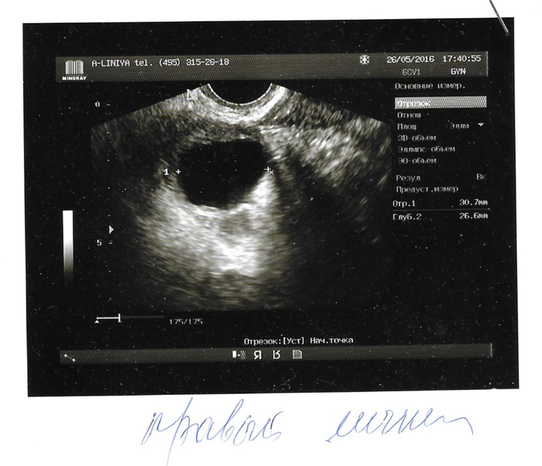 Тянет яичник при беременности на ранних. Овуляторный цикл по УЗИ что это. УЗИ кисты яичника и беременность. Киста или беременность УЗИ.