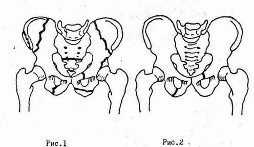 Переломы таза у детей презентация