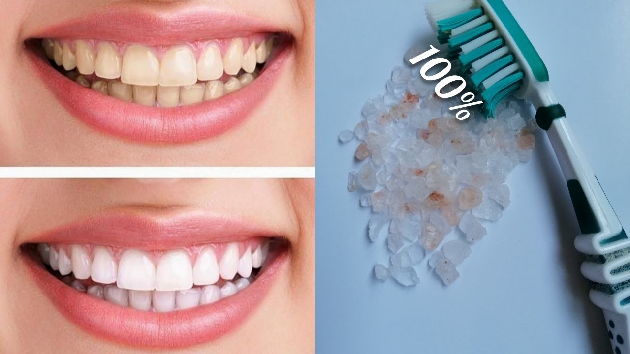 курс отбеливания зубов в домашних условиях