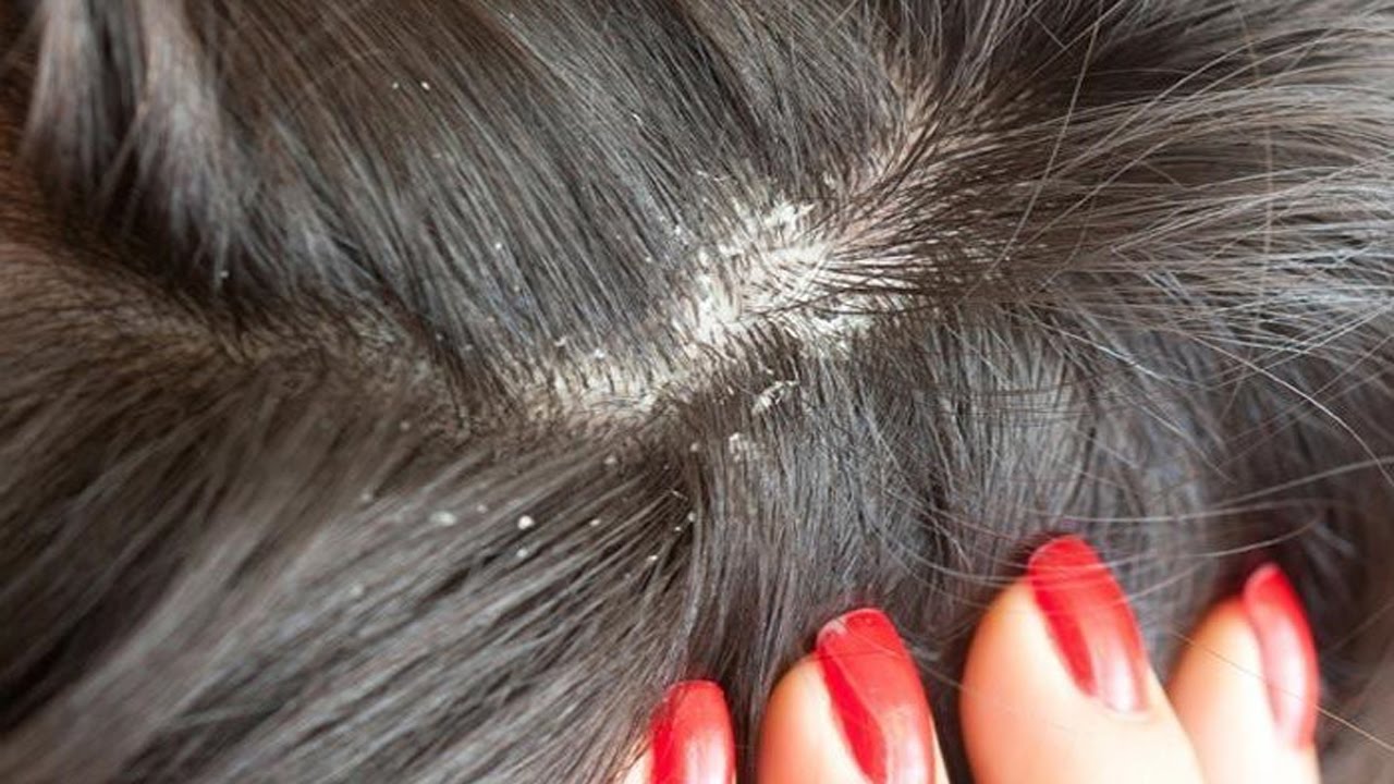 Себорея волосистой кожи головы