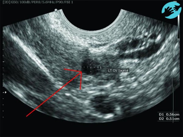 Овуляция на узи фото