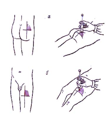Укол в бедро внутримышечно схема как сделать самому себе