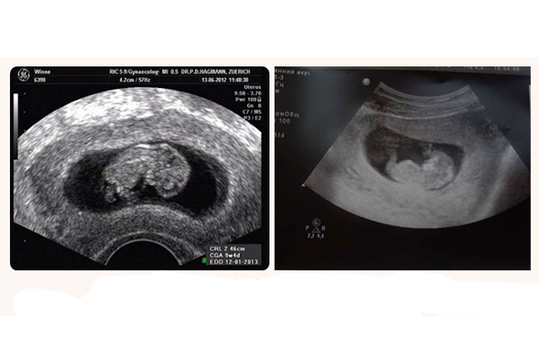 Плод 11 недель фото. УЗИ плод на 11 акушерской неделе. Эмбрион на 11 неделе беременности УЗИ. УЗИ на 11 неделе беременности на УЗИ.