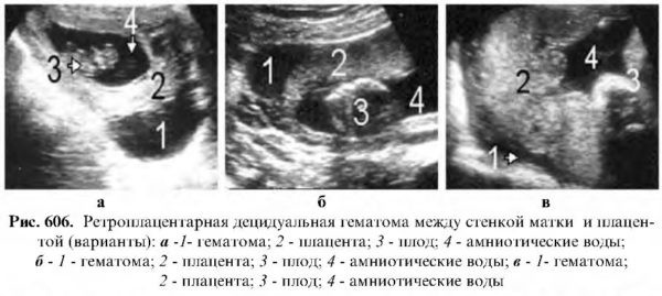 Отслойка 8 недель. Ретроплацентарная гематома на УЗИ. Ретрохориальные гематомы на раннем сроке беременности при УЗИ. Ретрохориальная гематома беременность.