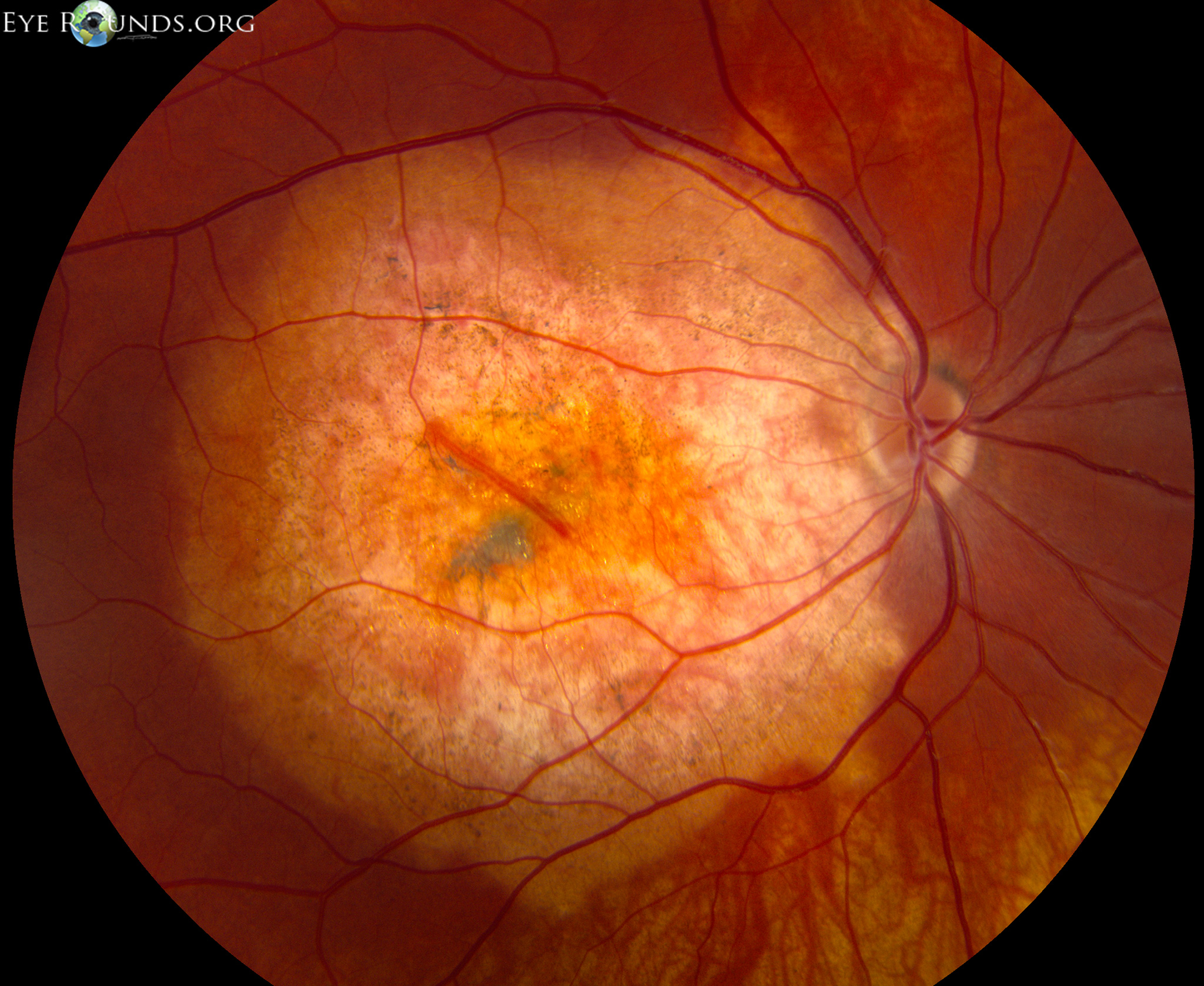 Непролиферативная диабетическая ретинопатия