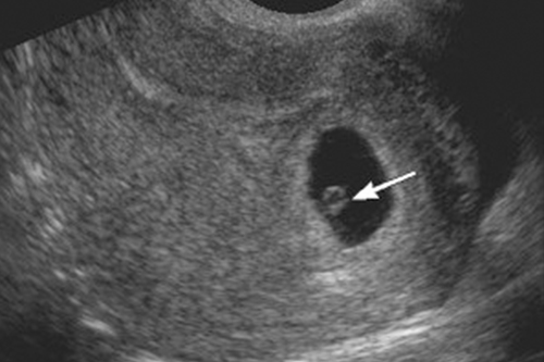 8 недель нет сердцебиения. УЗИ 6 недель беременности желточный мешок. Желточный мешок на 5 неделе беременности на УЗИ. Желточный мешок визуализируется 5мм. Плодное яйцо с эмбрионом и желточным мешком.