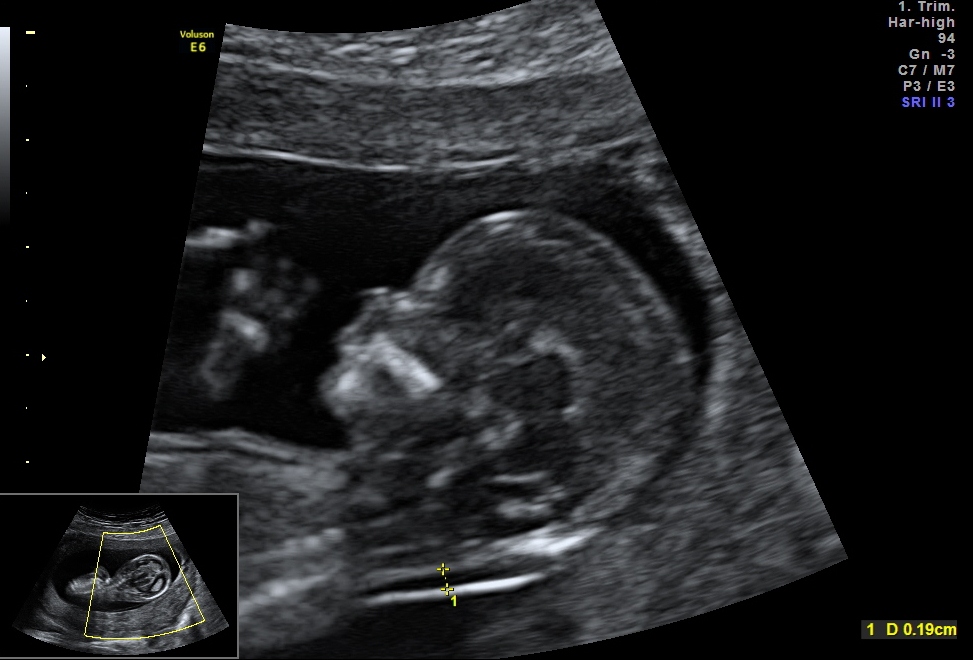 Фото ребенка 13 недель. УЗИ 13 недель беременности. Как выглядит плод на 13 неделе на УЗИ. Ребенок на 13 неделе беременности УЗИ. УЗИ на 13 неделибеременности.